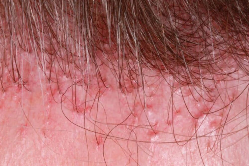 wat-is-frontale-fibroserende-alopecia-1